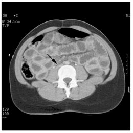 Miscellaneous conditions:Flattened IVC
